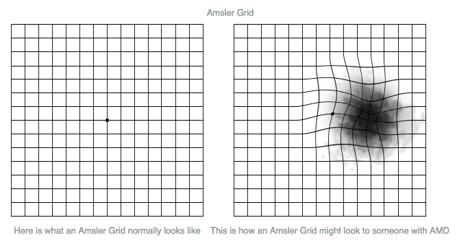Amsler Grid Test for Retinal Conditions, When to See a Doctor