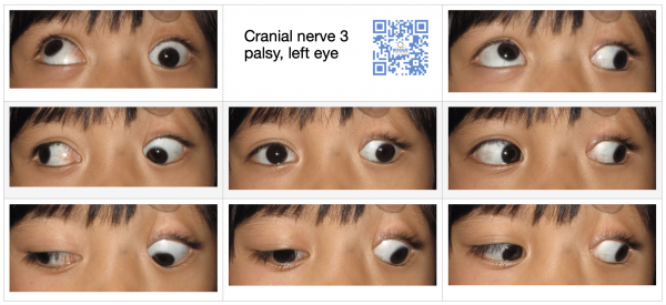 Cranial Nerve Palsy | 3rd nerve palsy | 4th nerve palsy | 6th nerve palsy