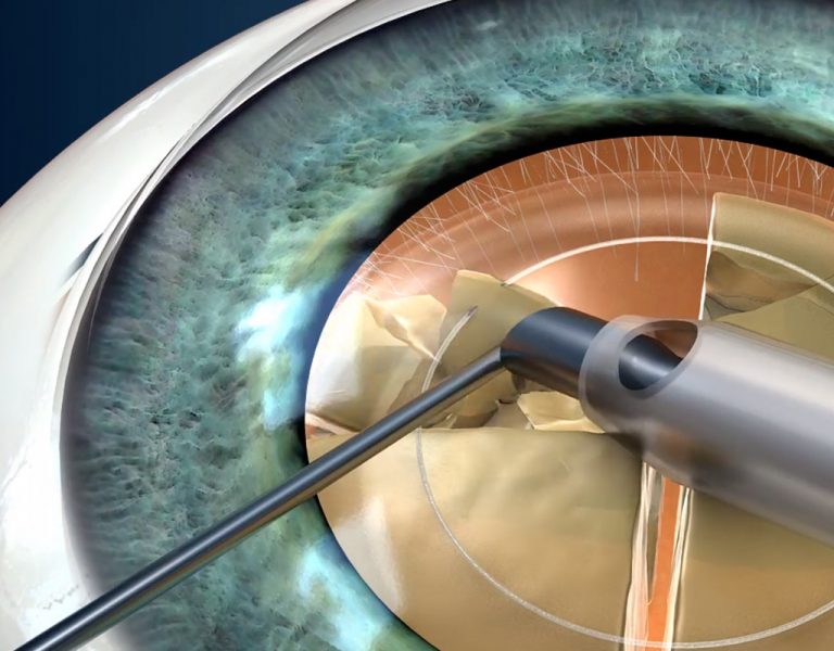 Phacoemulsification Cataract Surgery ROQUE Eye Clinic