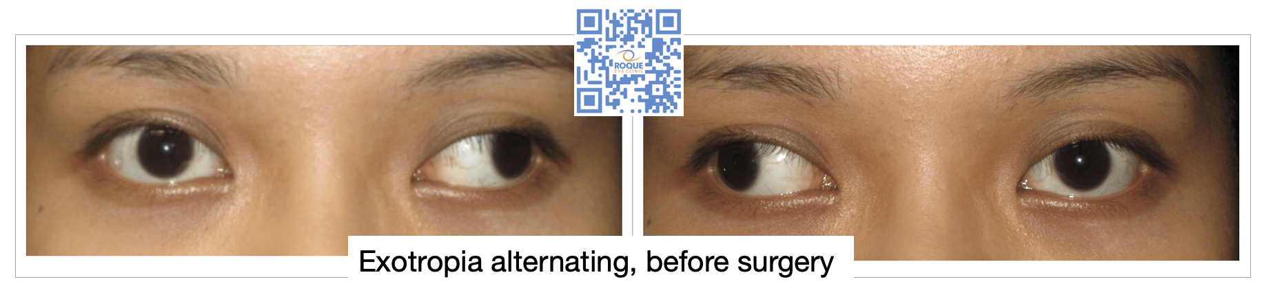 Strabismus Surgery Roque Eye Clinic Ph
