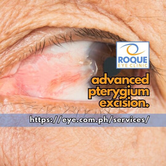 This image shows an established nasal pterygium which may benefit from advanced pterygium excision with conjunctival and amniotic membrane grafts.