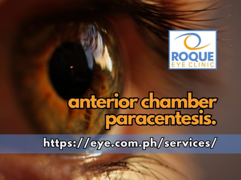 This image shows a magnified view of the eye ready for anterior chamber paracentesis, which is used for evaluations in diagnostic dilemmas.