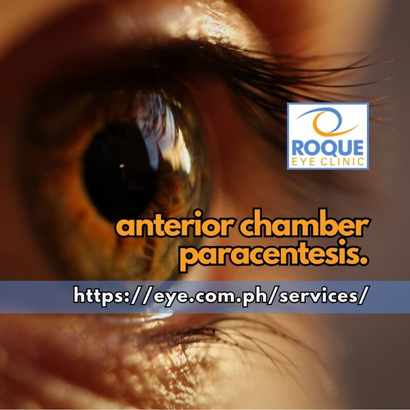 This image shows a magnified view of the eye ready for anterior chamber paracentesis, which is used for evaluations in diagnostic dilemmas.