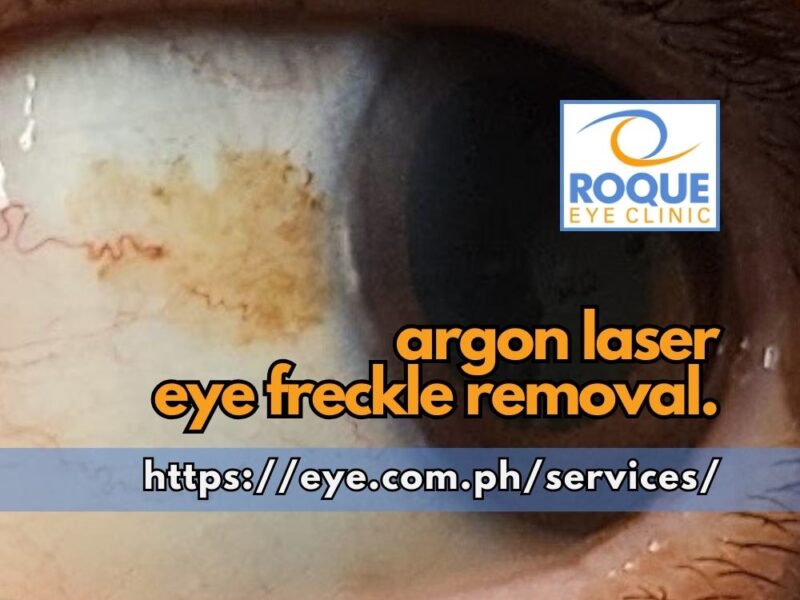 This image shows a benign superficial conjunctival melanotic lesion before cosmetic argon laser freckle removal.