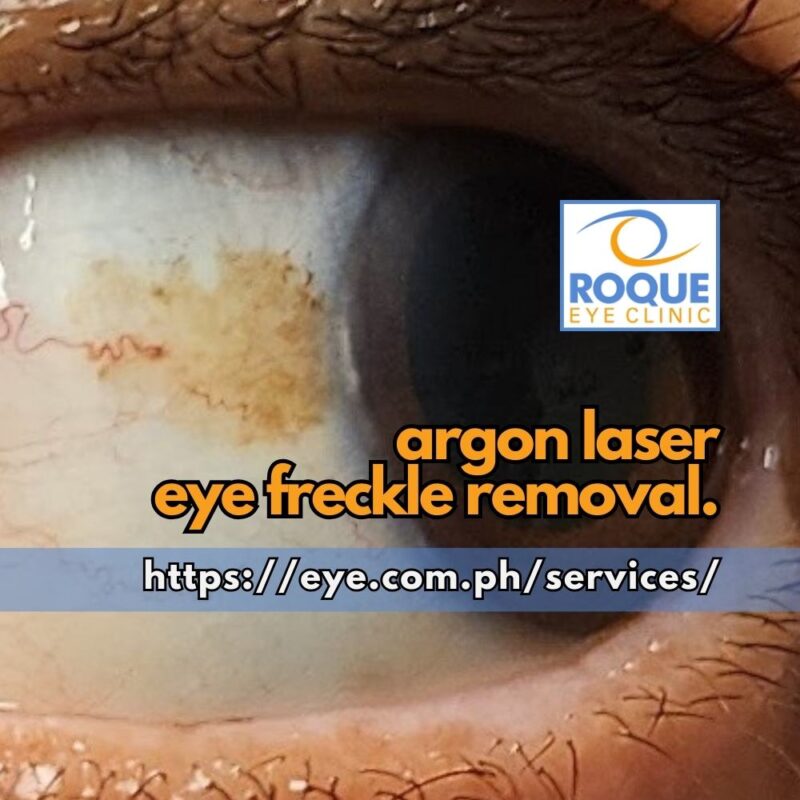 This image shows a benign superficial conjunctival melanotic lesion before cosmetic argon laser freckle removal.