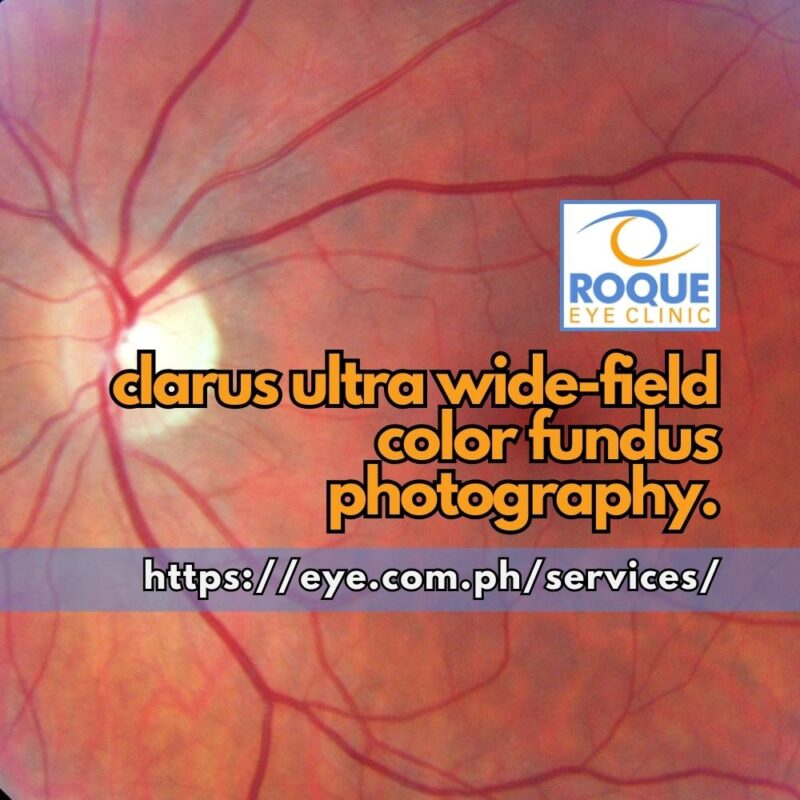 This image shows a normal retina image taken with a clarus ultra wide-field color fundus camera.