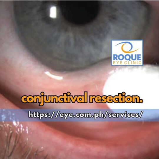 This image shows conjunctivochalasis, defined as a loose, redundant, non-edematous conjunctiva that is considered to occur secondary to normal aging, being evaluated for conjunctival resection.