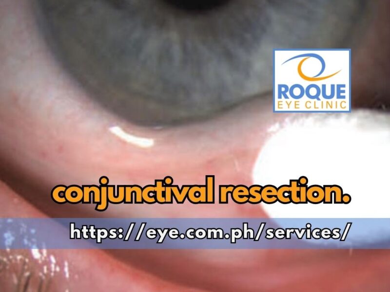 This image shows conjunctivochalasis, defined as a loose, redundant, non-edematous conjunctiva that is considered to occur secondary to normal aging, being evaluated for conjunctival resection.
