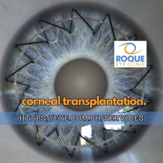 This image shows a cornea, showing the ocular structure treated with corneal transplantation.