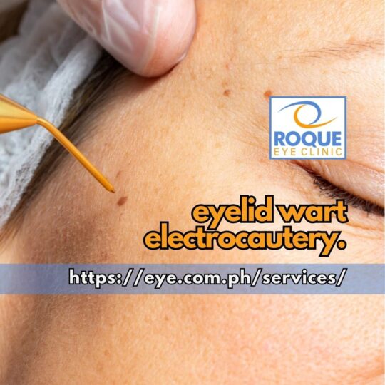 This image shows an electrocautery tip about to be applied to a flat wart.