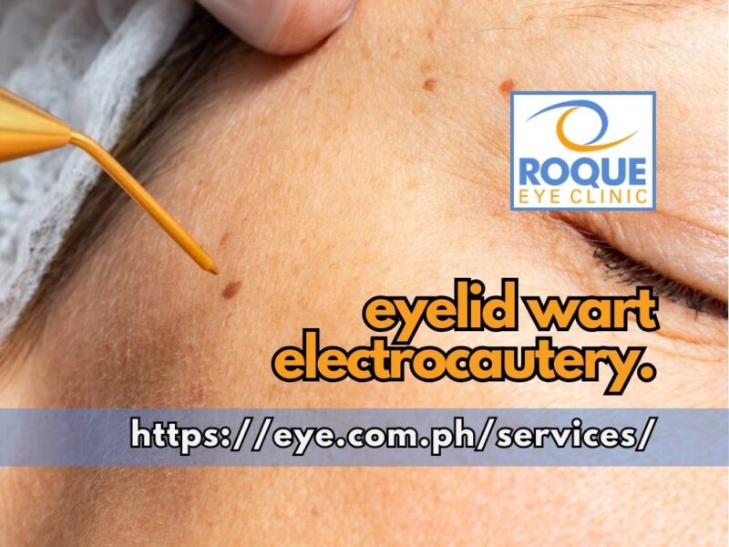This image shows an electrocautery tip about to be applied to a flat wart.