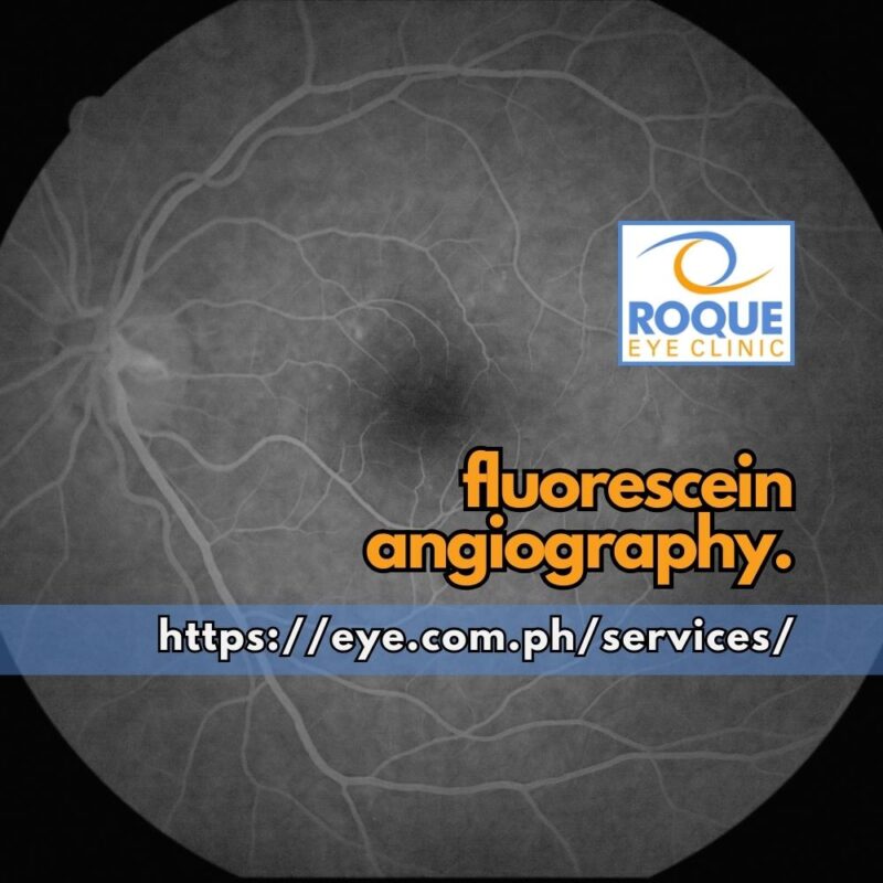 This image shows a late-stage image taken with fluorescein angiography.