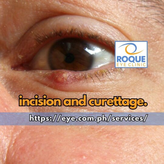 This image shows a stye on the lower eyelid of a patient due for incision and curettage.