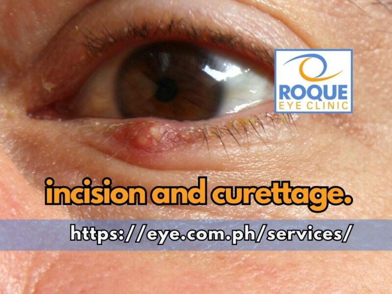 This image shows a stye on the lower eyelid of a patient due for incision and curettage.