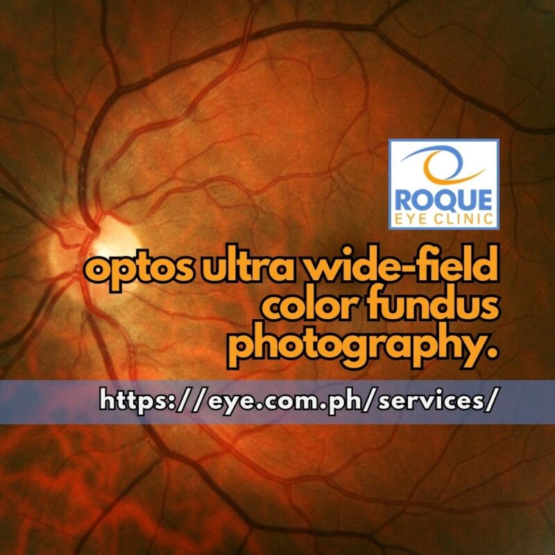This image shows an OPTOS ultra wide-field color fundus photo of the retina.