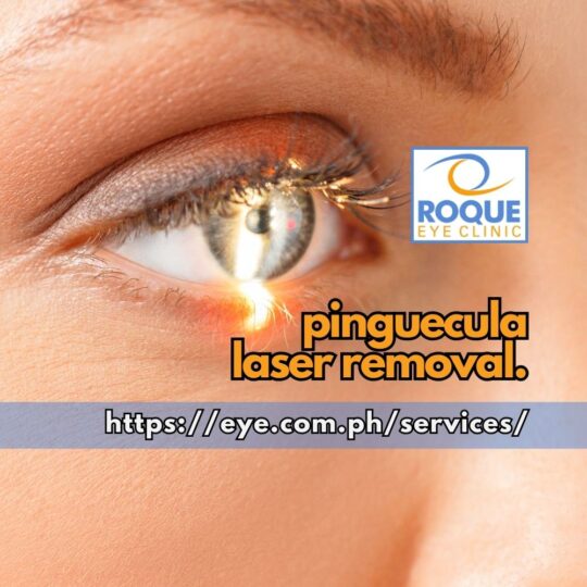 This is an image of the eye being examined under a slit lamp biomicroscope before pinguecula laser removal.