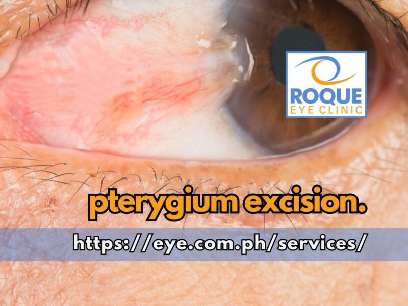 This is an image of an established nasal pterygium before pterygium excision.