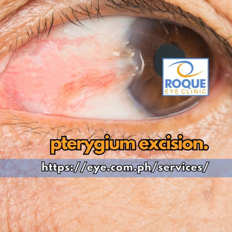 This is an image of an established nasal pterygium before pterygium excision.