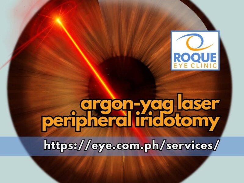 Argon-YAG Laser Peripheral Iridotomy
