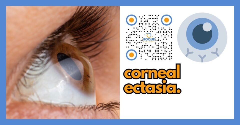 EXTERNAL DISEASES AND CORNEA - CORNEAL ECTASIA