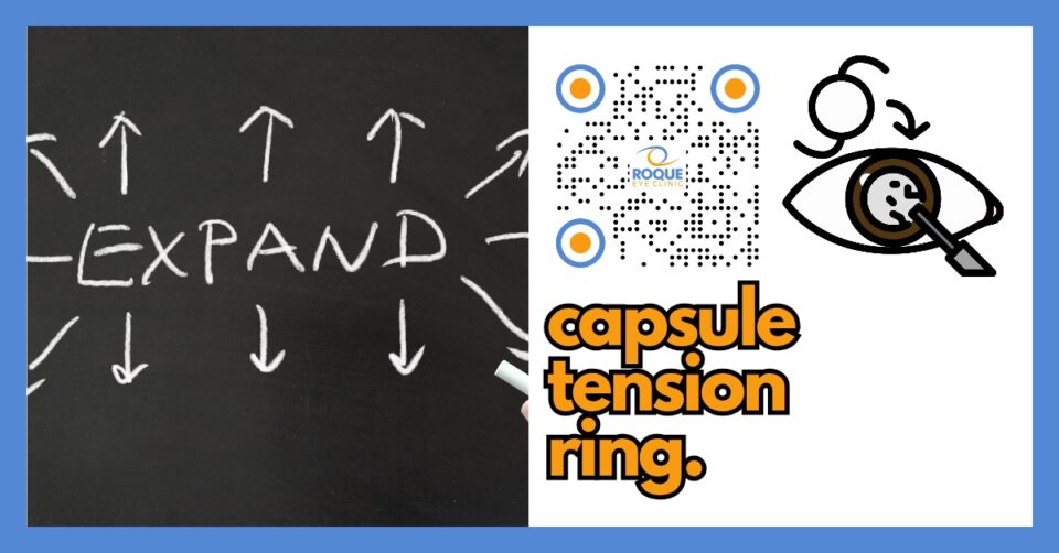LENS AND CATARACT BLOG - CAPSULE TENSION RING