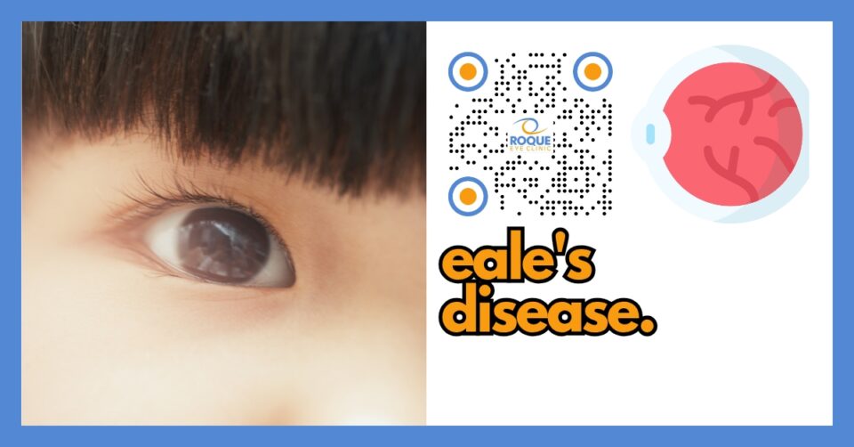 RETINA AND VITREOUS BLOG - EALE'S DISEASE