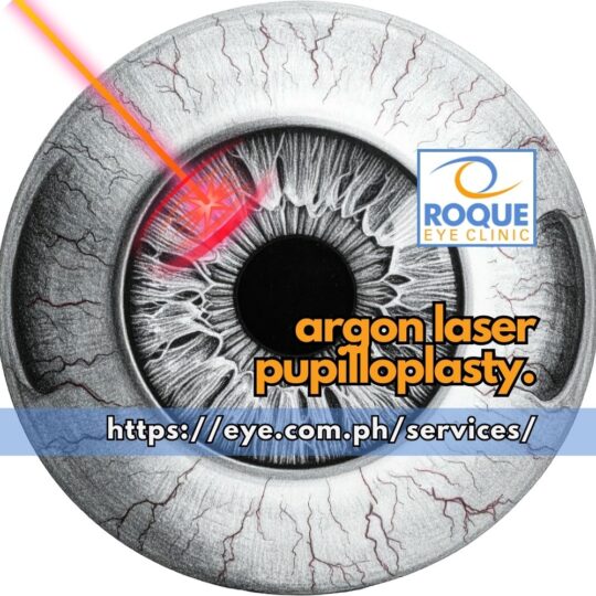 ARGON LASER PUPILLOPLASTY