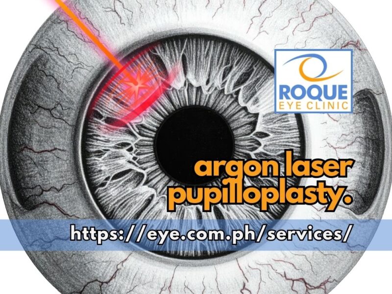 ARGON LASER PUPILLOPLASTY