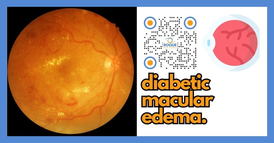 DIABETIC MACULAR EDEMA