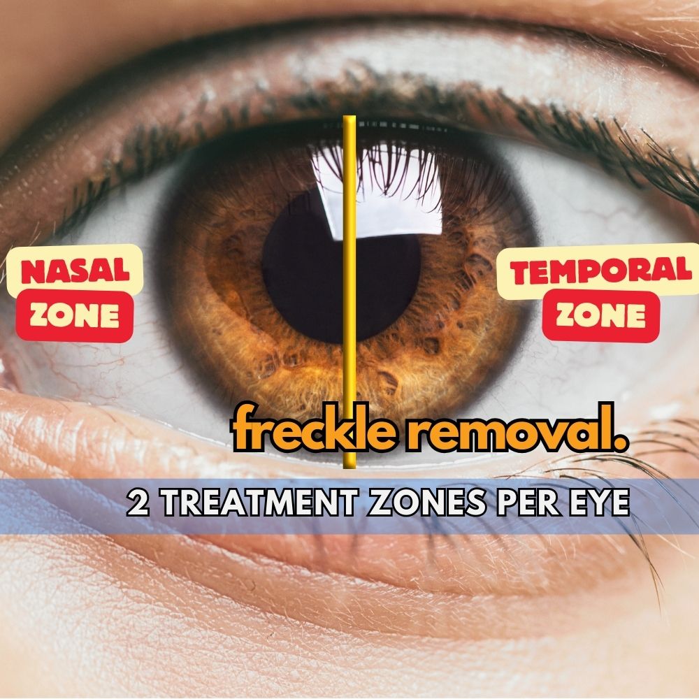 two treatment zones per eye