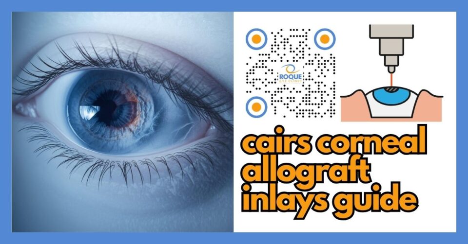 Medical illustration of CAIRS corneal allograft inlays using donor tissue segments for keratoconus