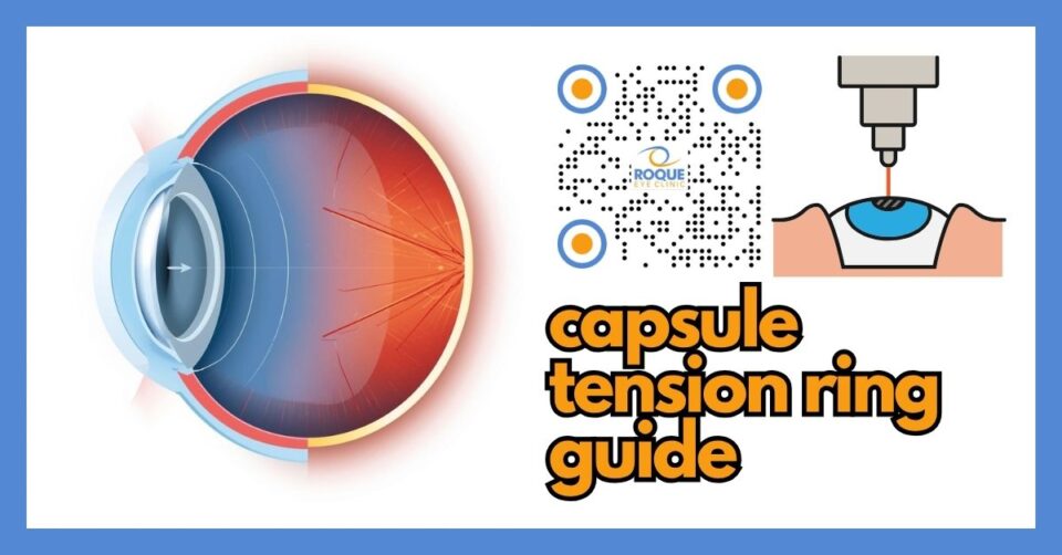 Cross-sectional eye illustration showing a capsule tension ring supporting the capsular bag during lens surgery