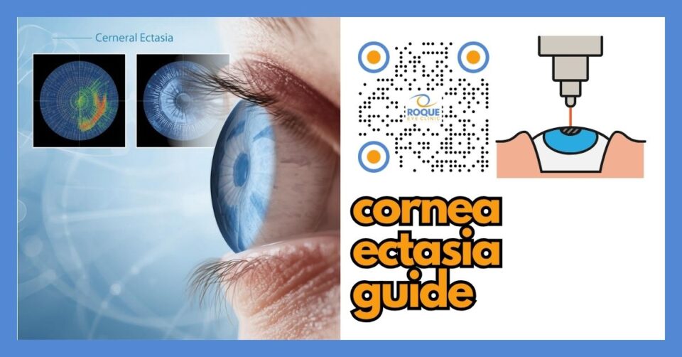 Corneal ectasia illustration with corneal imaging and irregular corneal shape