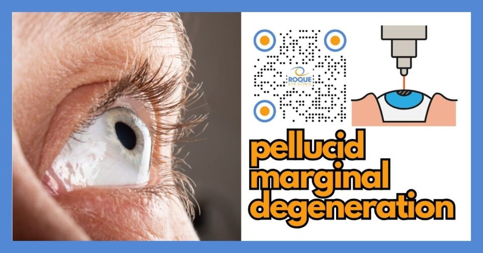 Corneal imaging and topography illustrating pellucid marginal degeneration in a clinical ophthalmology setting