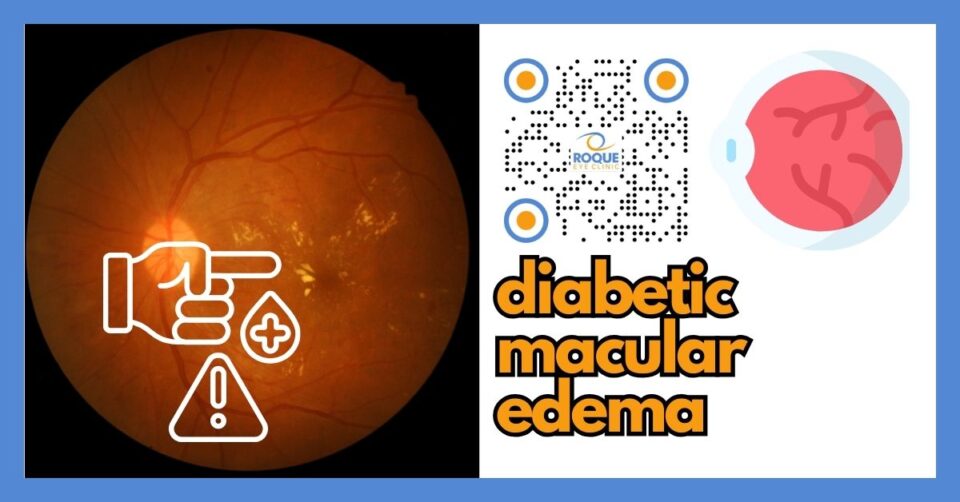 Diabetic macular edema showing swelling of the macula that causes blurry central vision