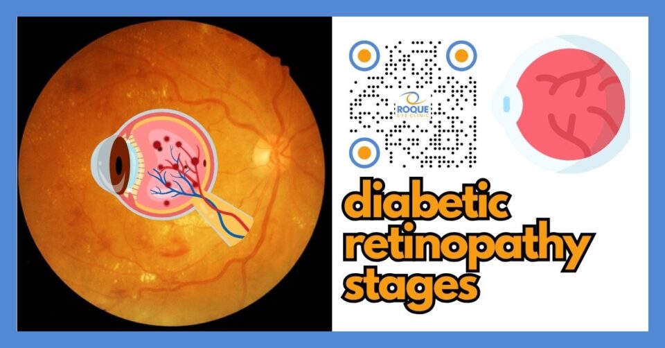 Diabetic retinopathy stages from mild NPDR to proliferative diabetic retinopathy PDR explained