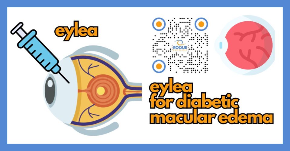 Educational illustration showing Eylea treatment for diabetic macular edema