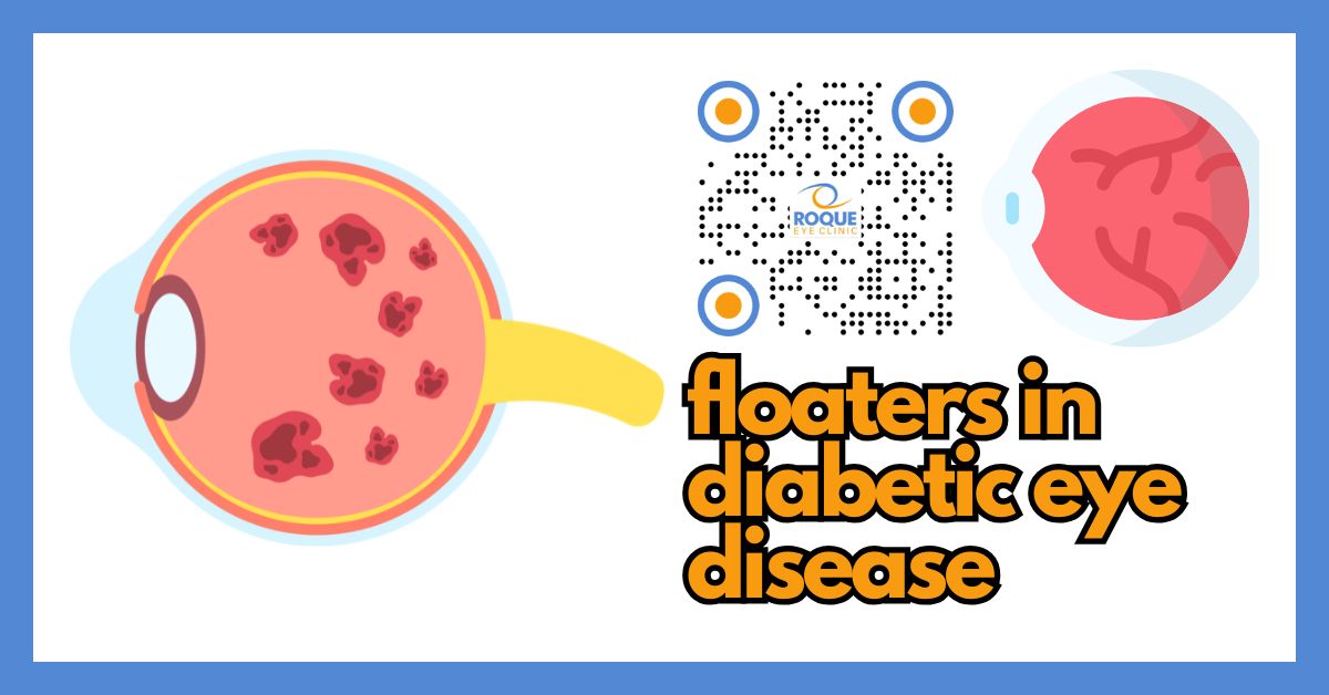 Guilda Floaters Floaters in Diabetic Eye Disease (Warning Sign of Retinal Bleeding)