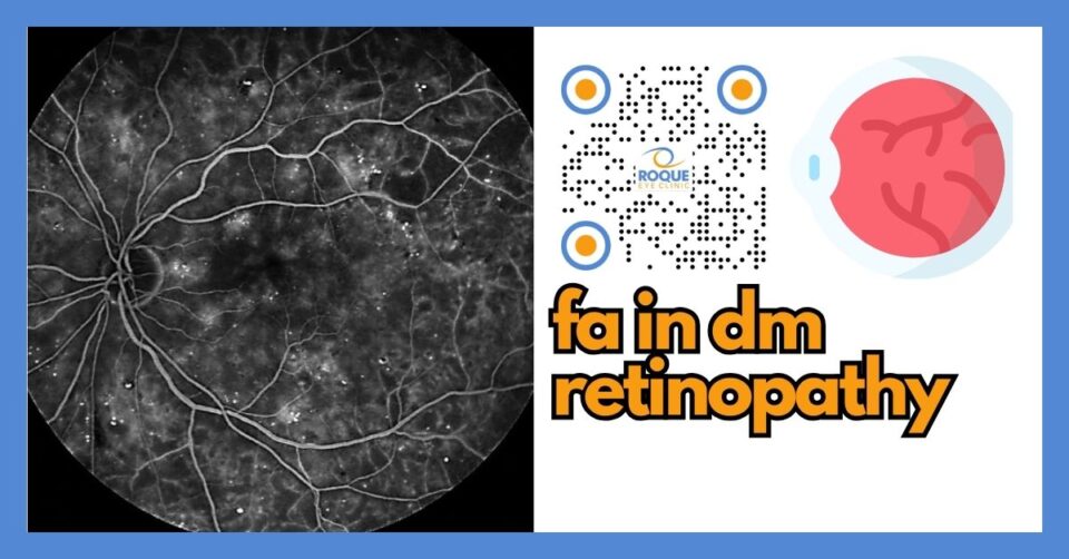 Illustration showing fluorescein angiography highlighting leaking retinal blood vessels in diabetic retinopathy
