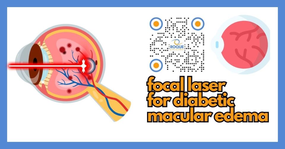 Illustration of focal laser treatment targeting leaking spots in diabetic macular edema