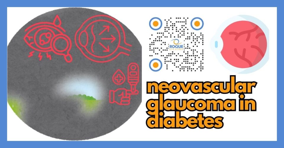 Medical illustration showing neovascular glaucoma in diabetes with abnormal new blood vessels in the iris and drainage angle
