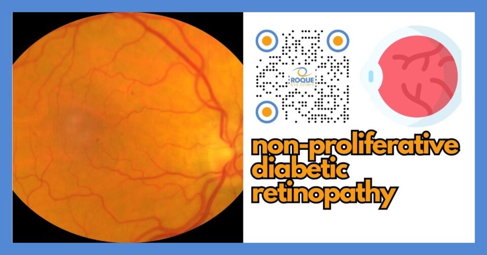 Medical illustration of non-proliferative diabetic retinopathy showing retinal microaneurysms, hemorrhages, and diabetic macular edema