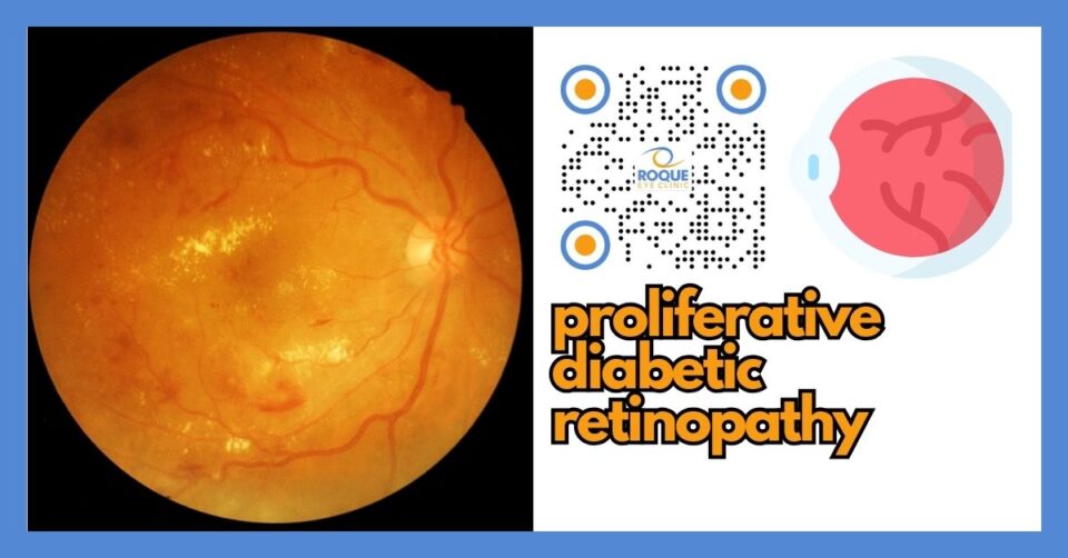 Illustration showing abnormal new blood vessels in proliferative diabetic retinopathy