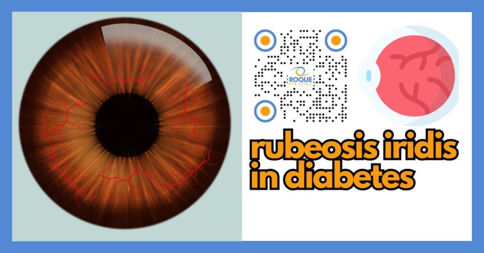 Illustration of abnormal new blood vessels on the iris caused by diabetic eye disease