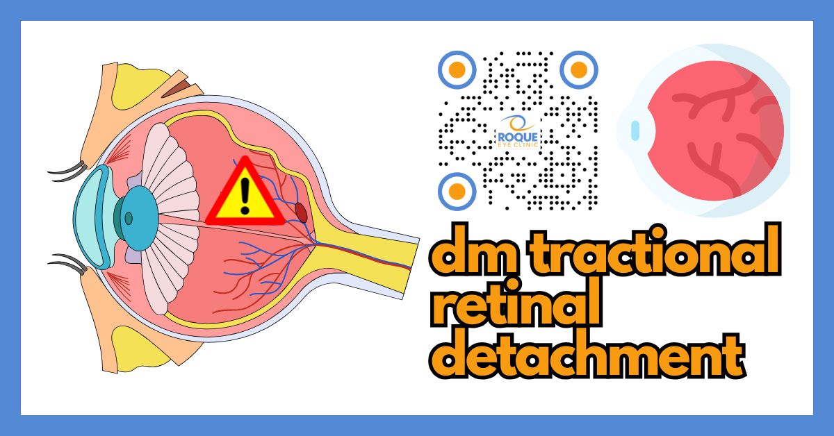 Tractional Rd Oct Tractional Retinal Detachment in Diabetes: Symptoms, Surgery, and Recovery