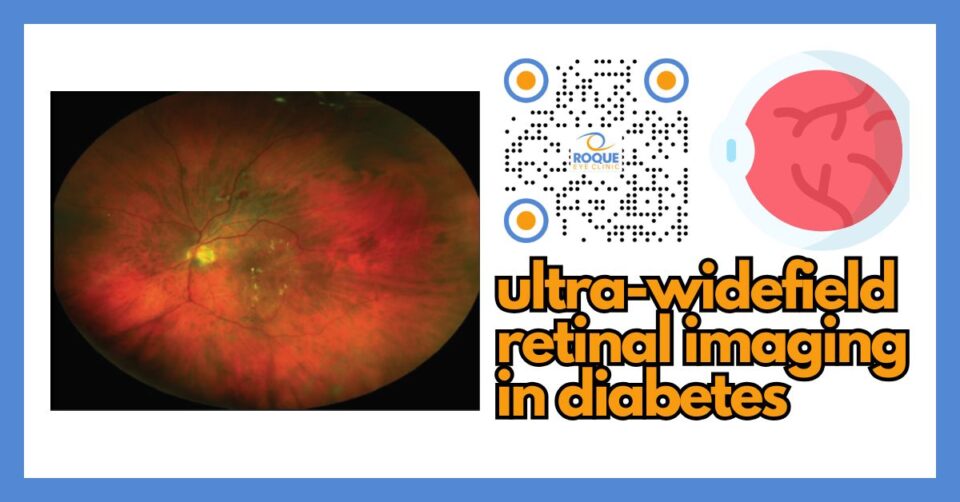 Ultra-widefield retinal imaging showing a wide panoramic view of the retina in a patient with diabetic retinopathy