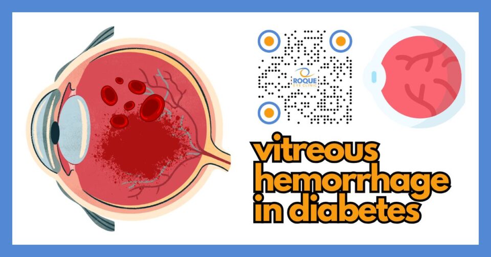 Illustration showing vitreous hemorrhage caused by diabetic retinopathy inside the eye