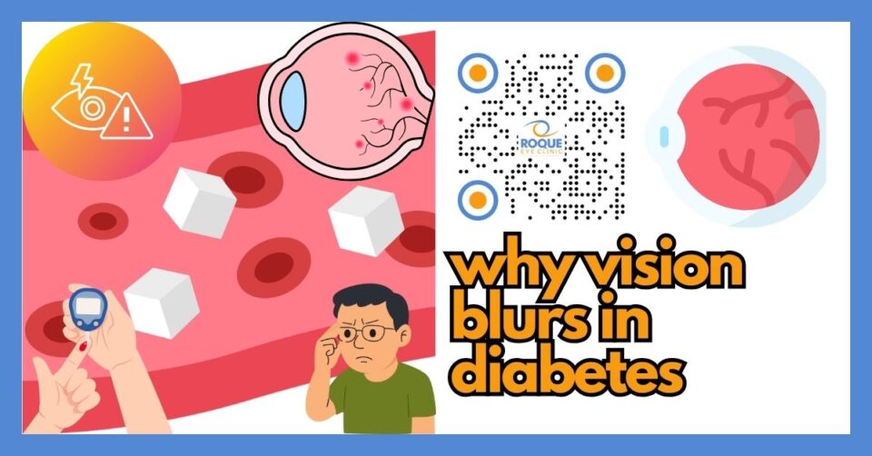 Why vision blurs with diabetes showing common causes like blood sugar swings, dry eye, cataract, and diabetic macular edema