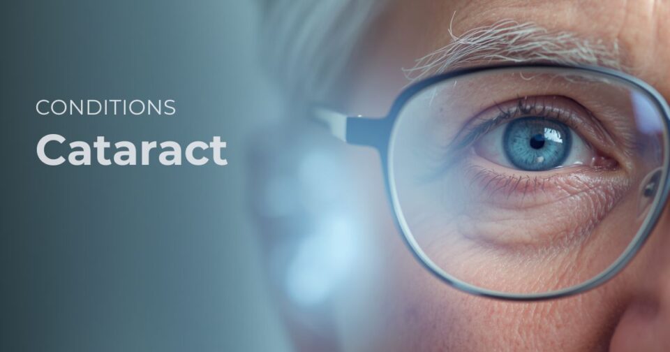 Eye illustration representing cataract or a cloudy natural lens causing blurred vision