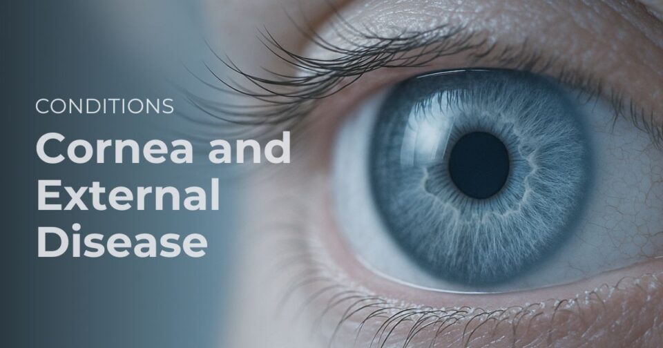 Close-up illustration of the cornea and eye surface for a cornea and external disease article